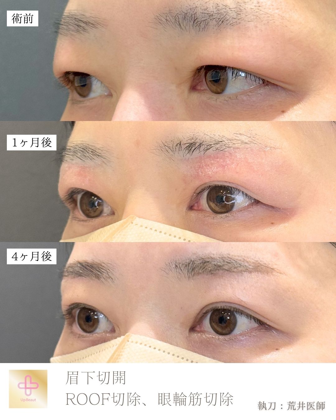 眼輪筋切除