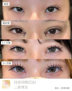 二重埋没