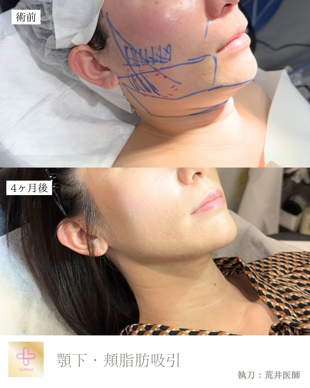 小顔脂肪吸引