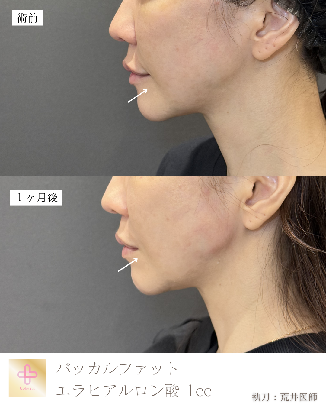 バッカルファット