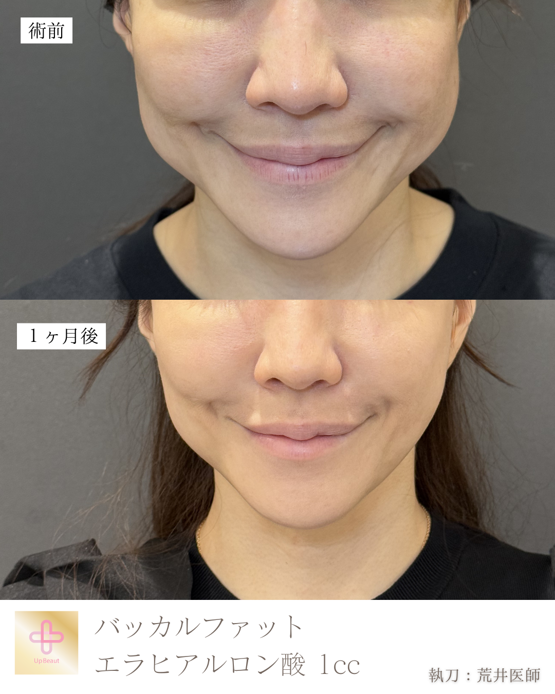 バッカルファット