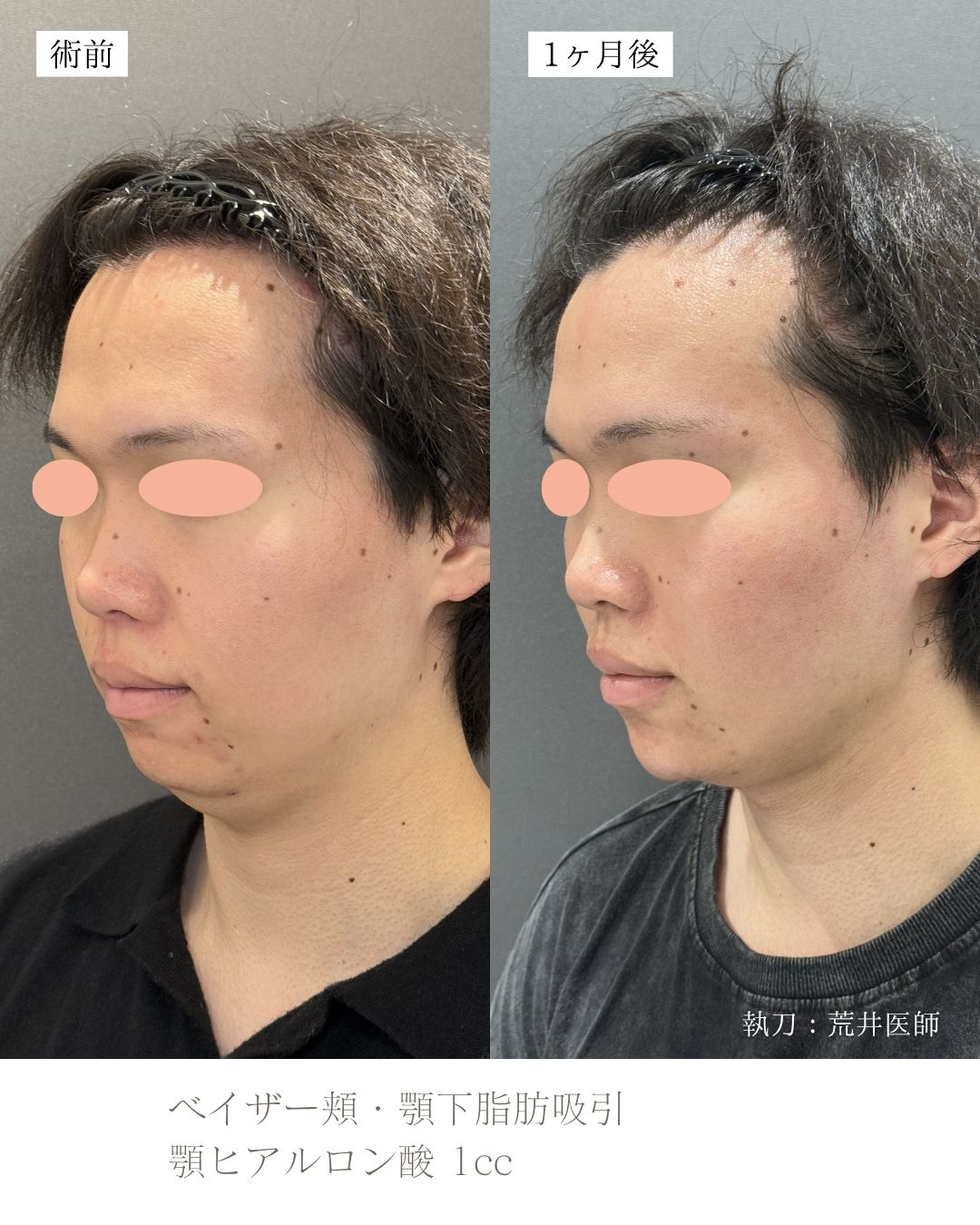 顎下脂肪吸引