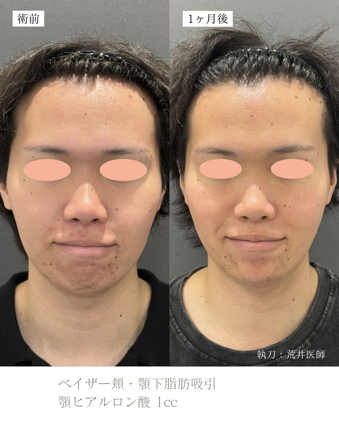 顎下脂肪吸引