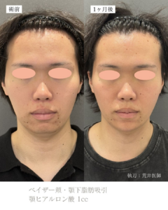 顎下脂肪吸引