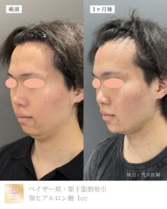 顎ヒアルロン酸