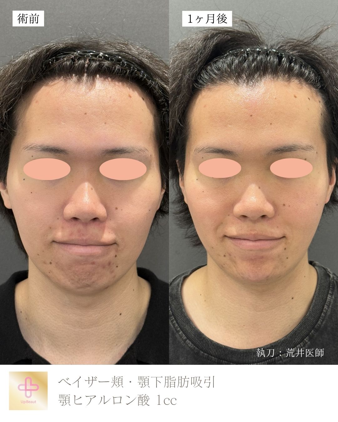 小顔脂肪吸引