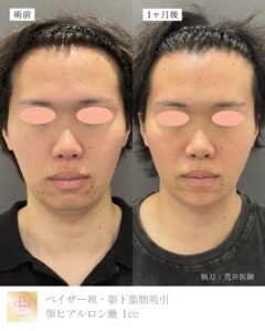 小顔脂肪吸引