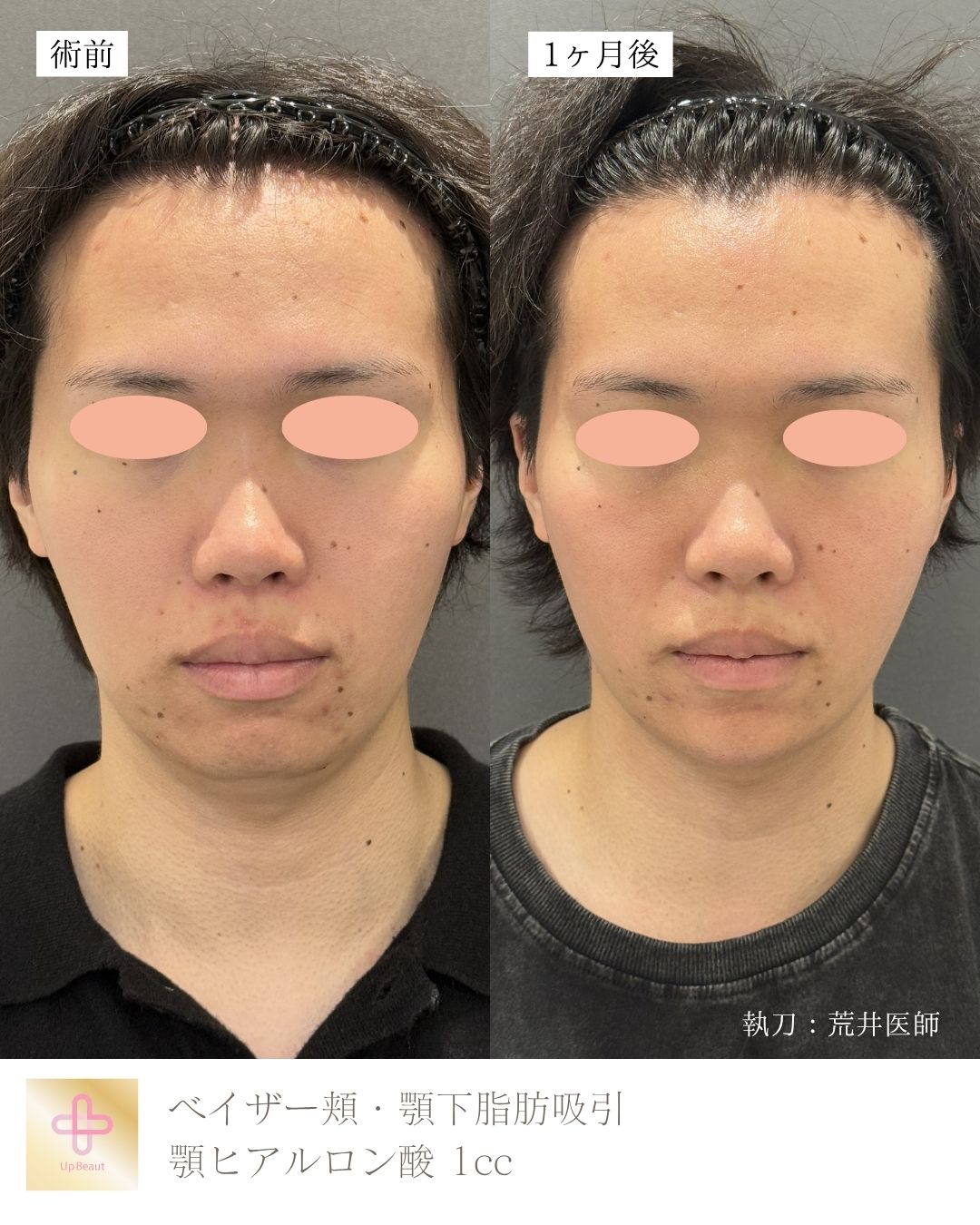 小顔脂肪吸引