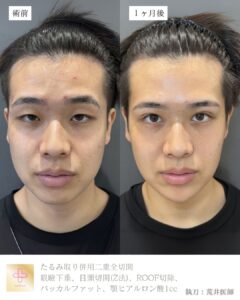 バッカルファット