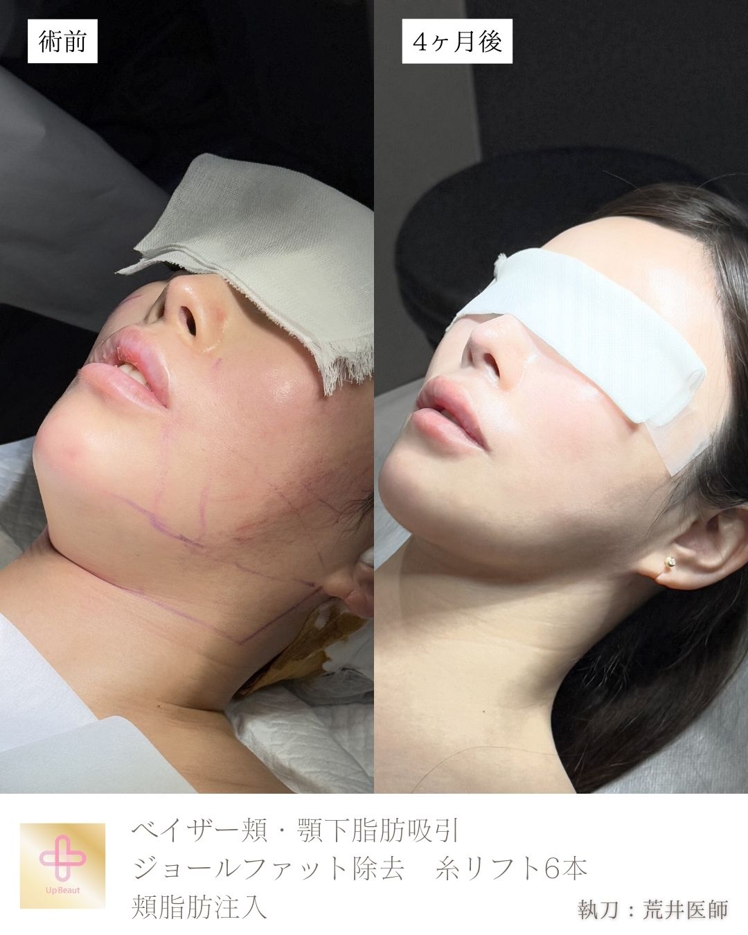 小顔脂肪吸引、ジョールファット、頬脂肪注入