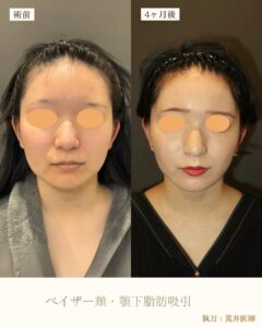 小顔脂肪吸引