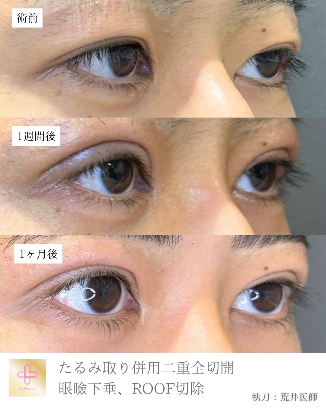 たるみ取り併用全切開二重術、眼瞼下垂 、ROOF切除