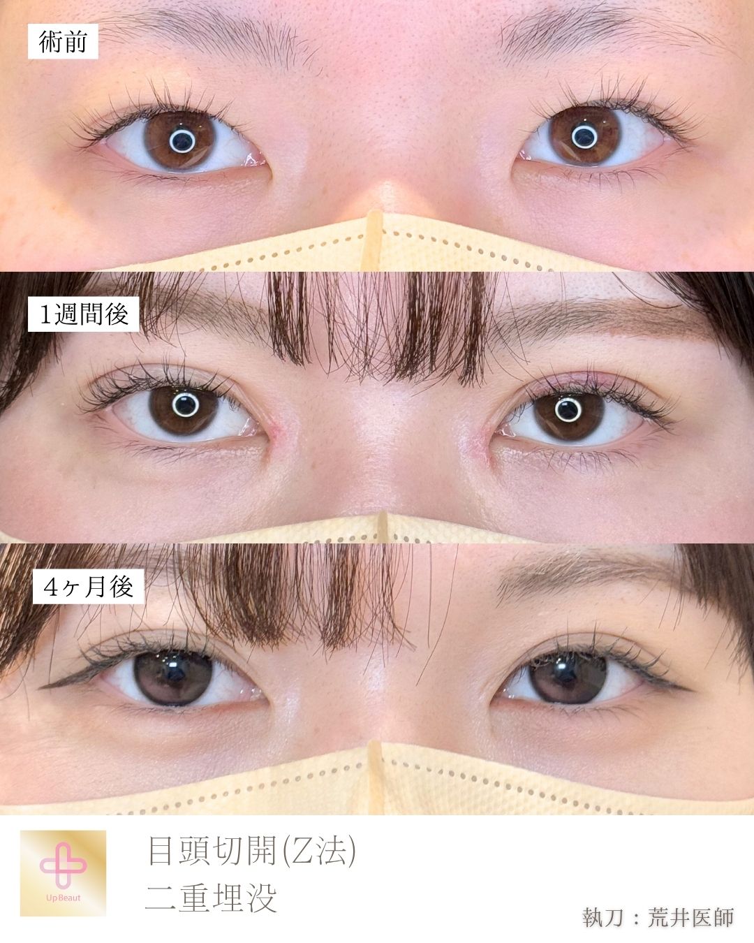 埋没法 表留めダブル、目頭切開（Z法 ）