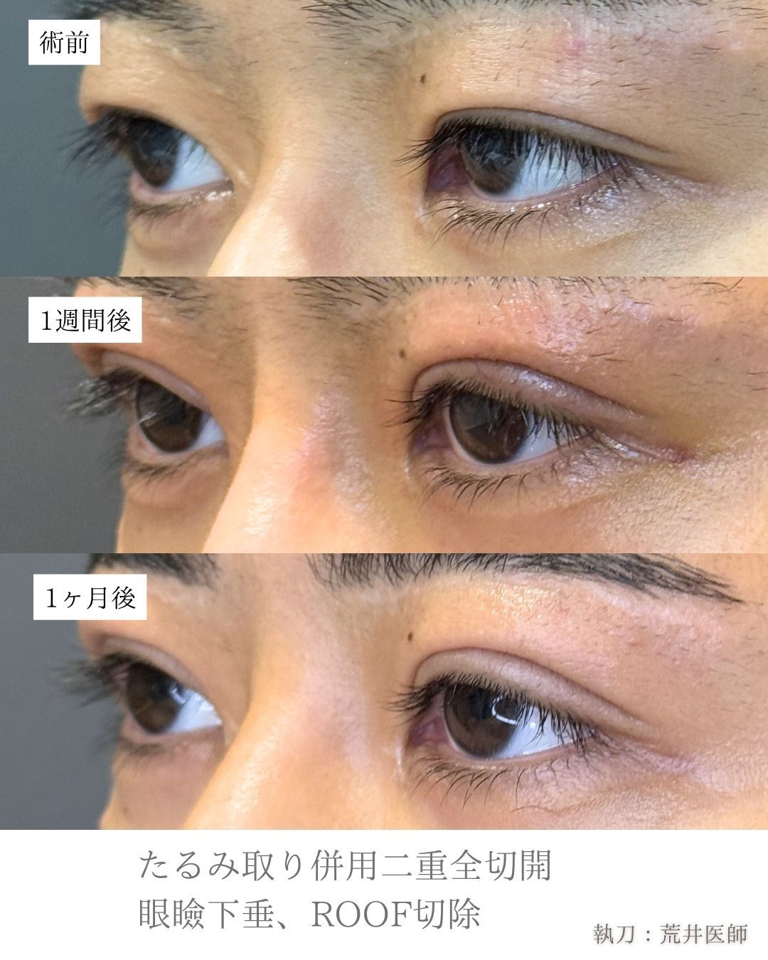 眼瞼下垂二重整形症例