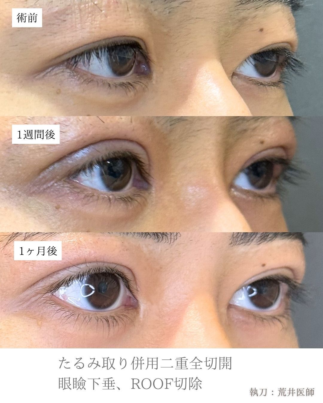 眼瞼下垂二重整形症例