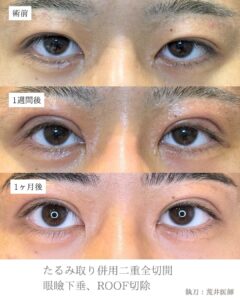 眼瞼下垂二重整形症例