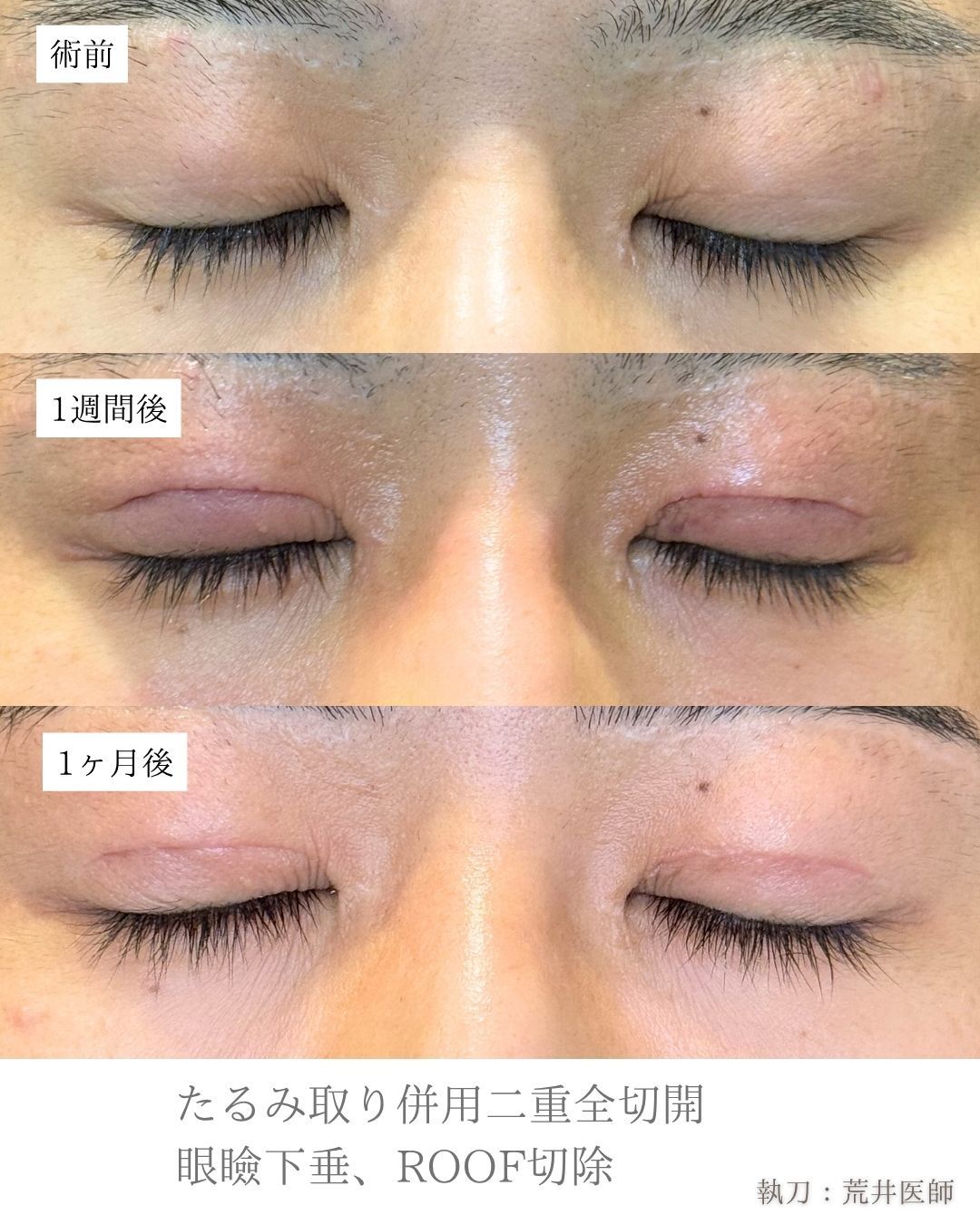 眼瞼下垂二重整形症例
