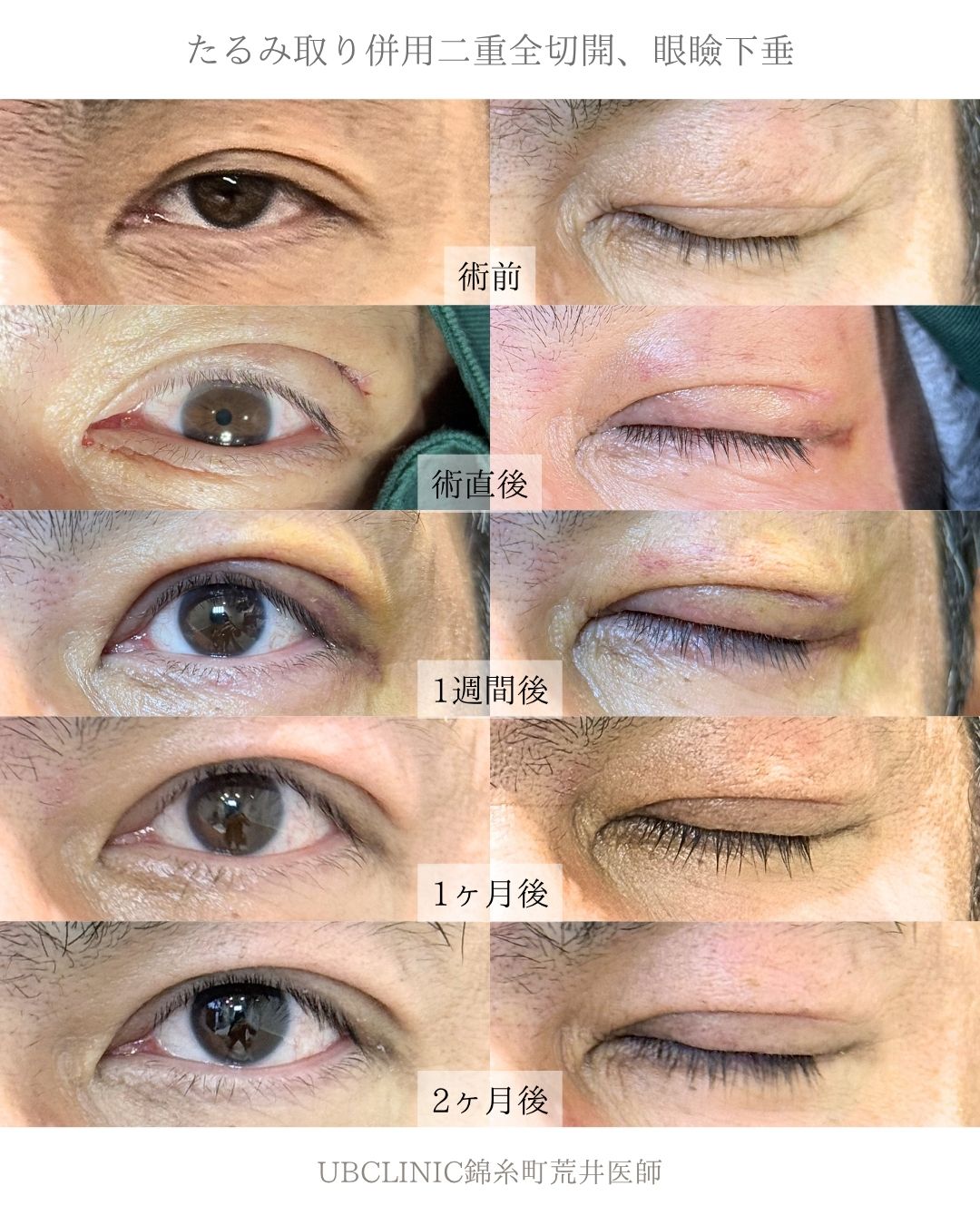 たるみ取り併用二重全切開、眼瞼下垂