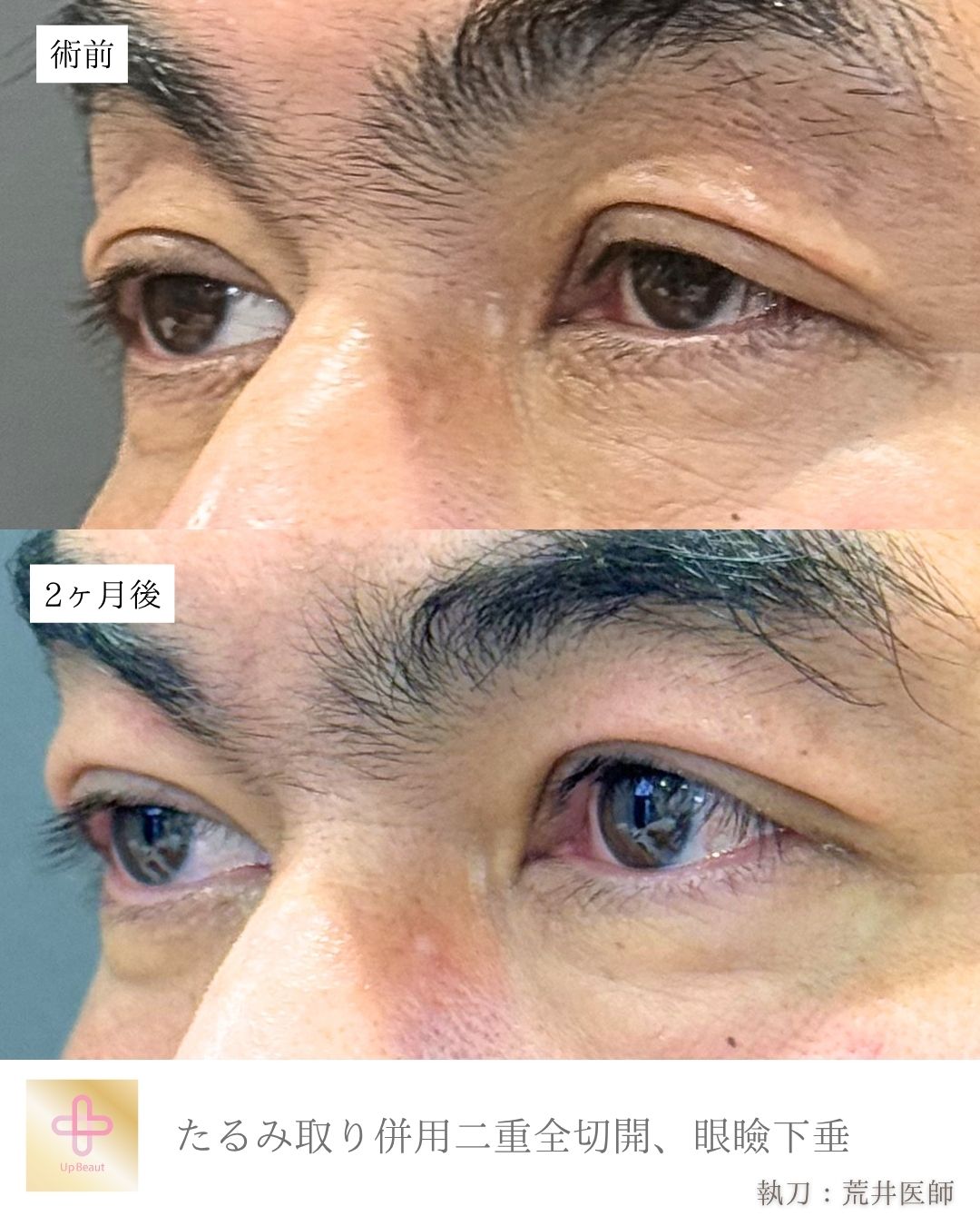 たるみ取り併用二重全切開、眼瞼下垂