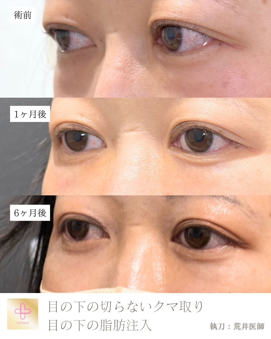 目の下の脱脂、脂肪注入（ゴルゴ、目の下）