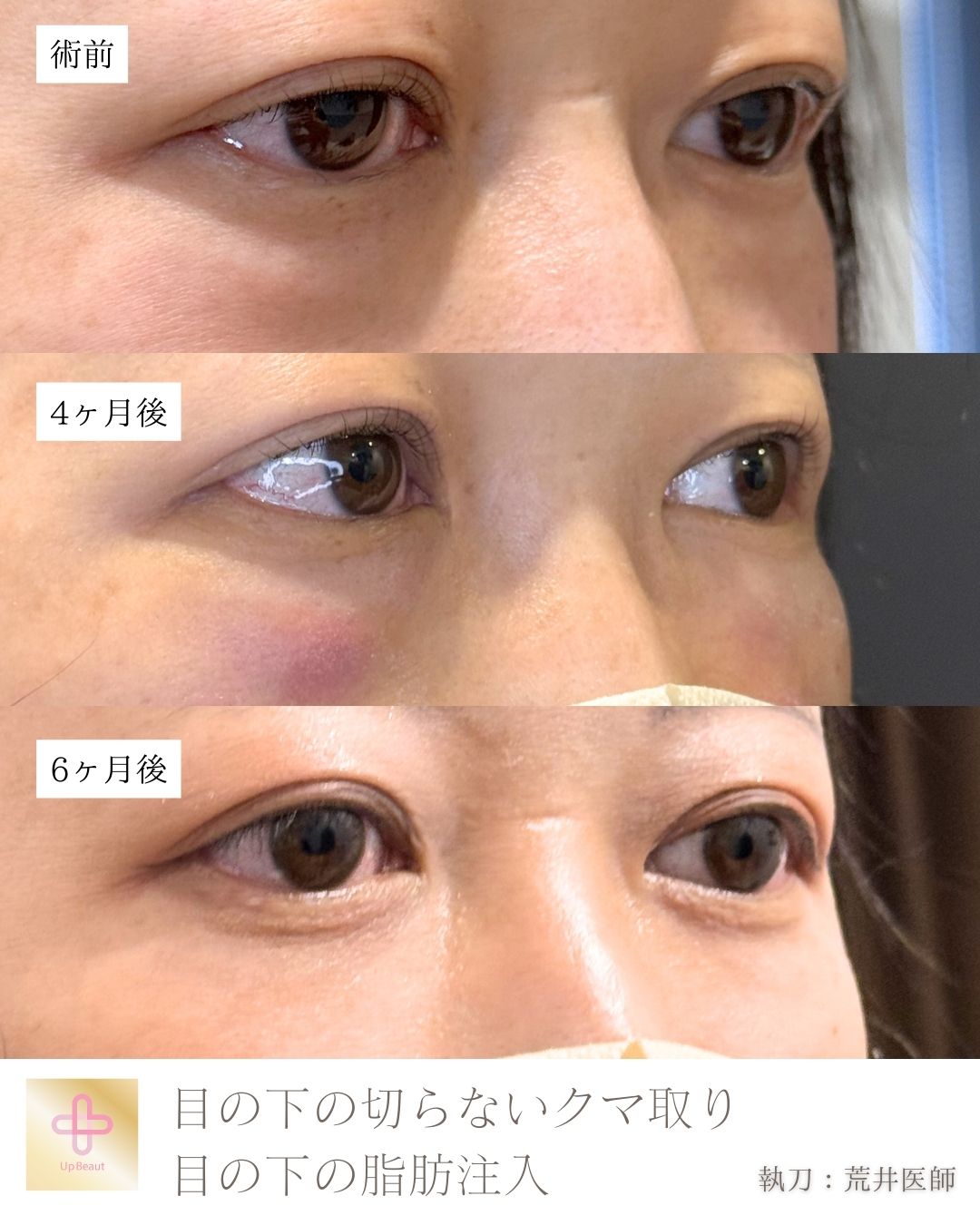 目の下の脱脂、脂肪注入（ゴルゴ、目の下）