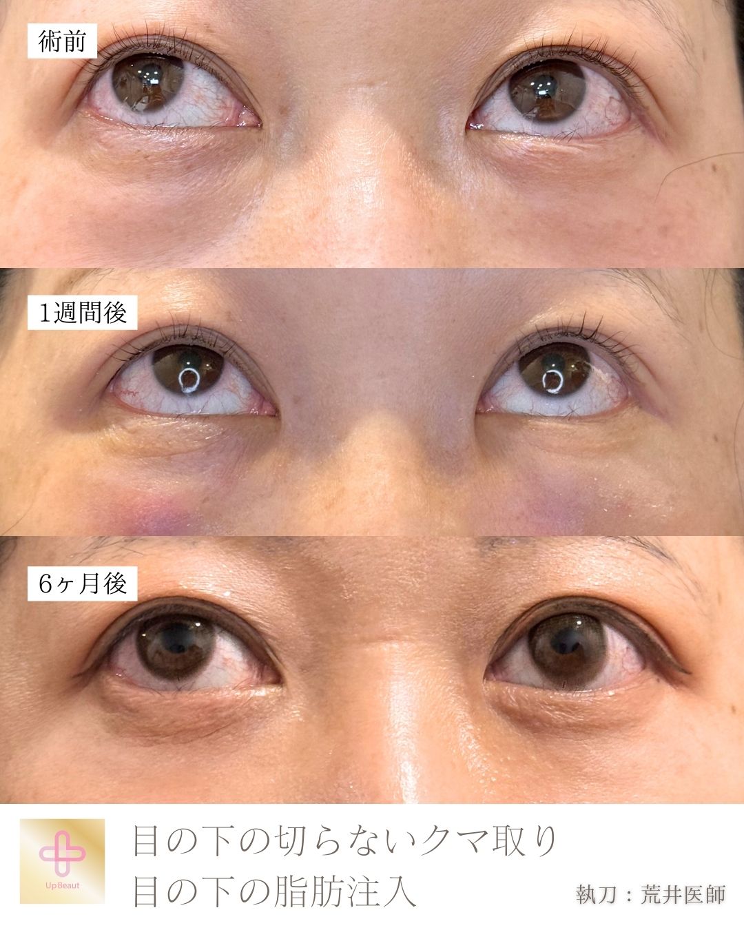 目の下の脱脂、脂肪注入（ゴルゴ、目の下）