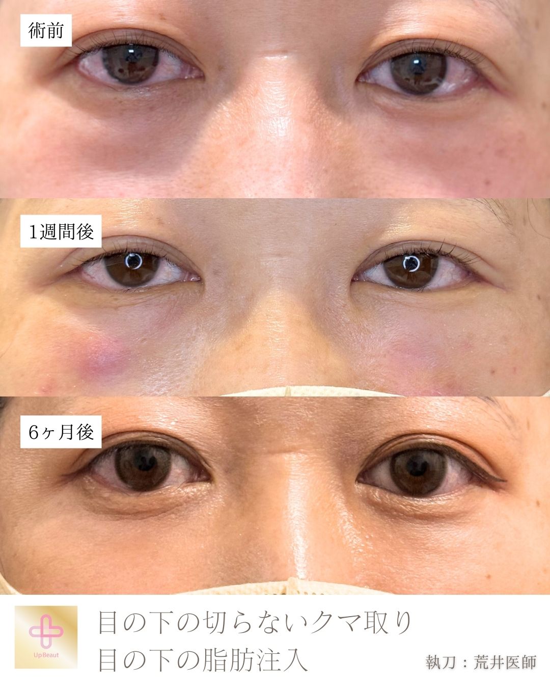 目の下の脱脂、脂肪注入（ゴルゴ、目の下）