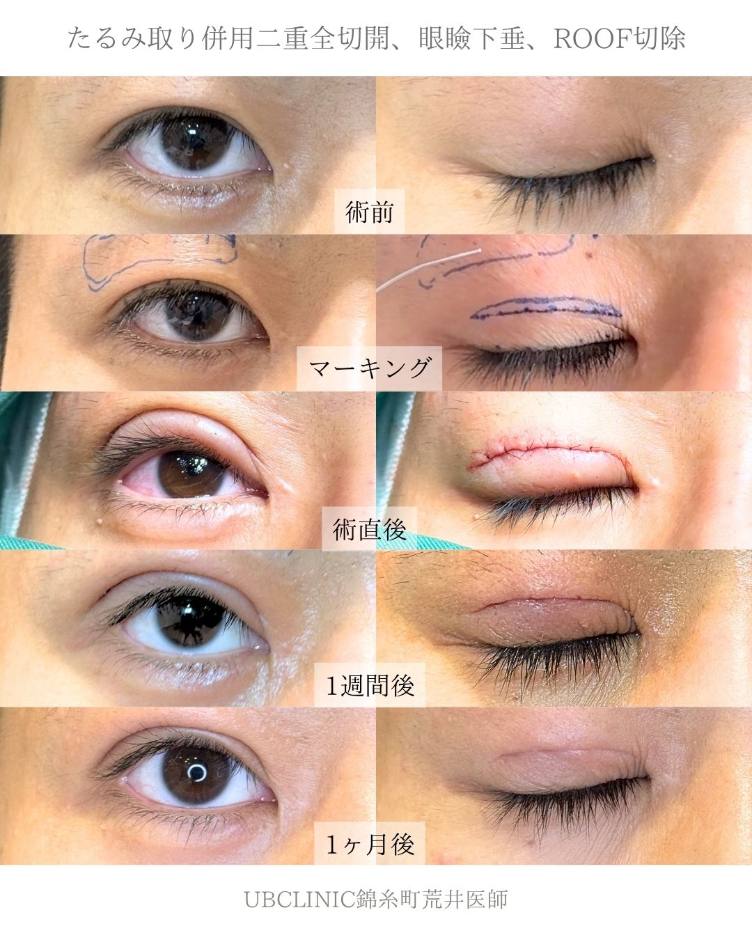 たるみ取り併用全切開二重術、眼瞼下垂 、ROOF切除