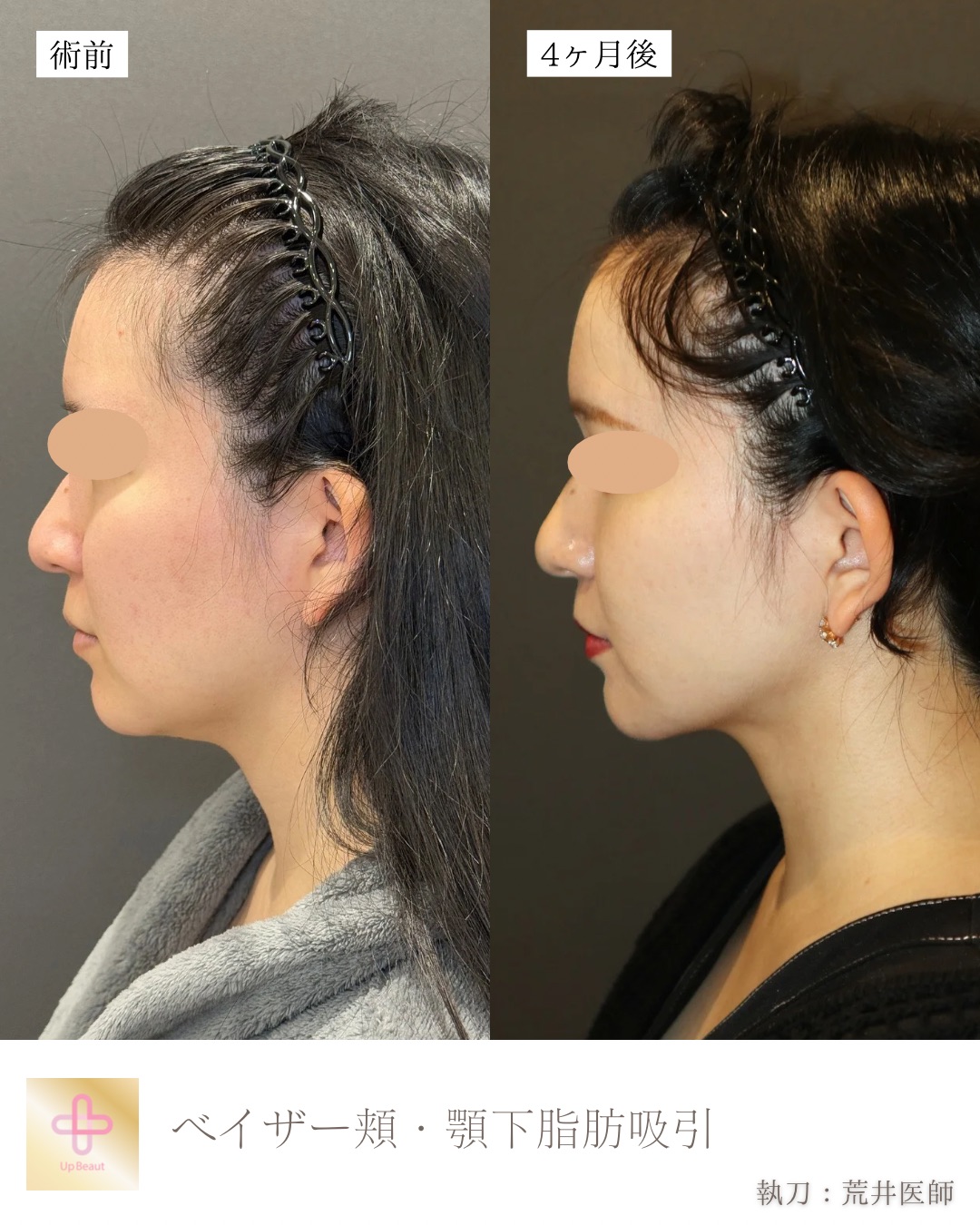 小顔脂肪吸引、エラボトックス
