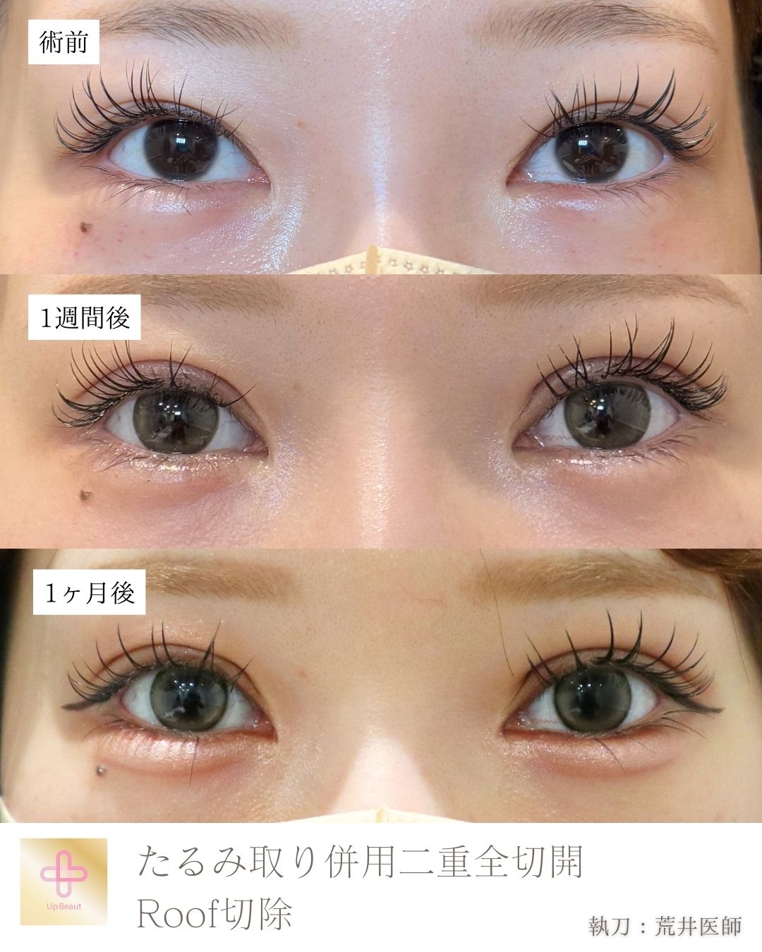 二重全切開たるみ取り併用、ROOF切除