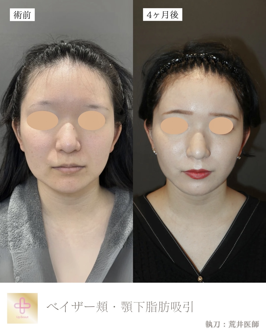 小顔脂肪吸引、エラボトックス