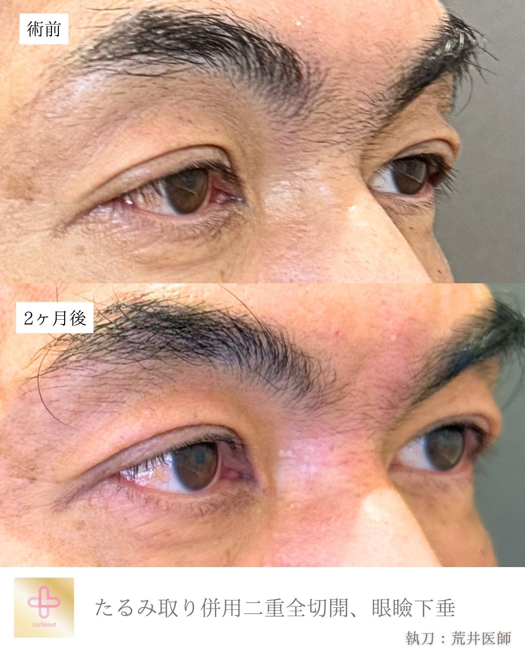 たるみ取り併用二重全切開、眼瞼下垂