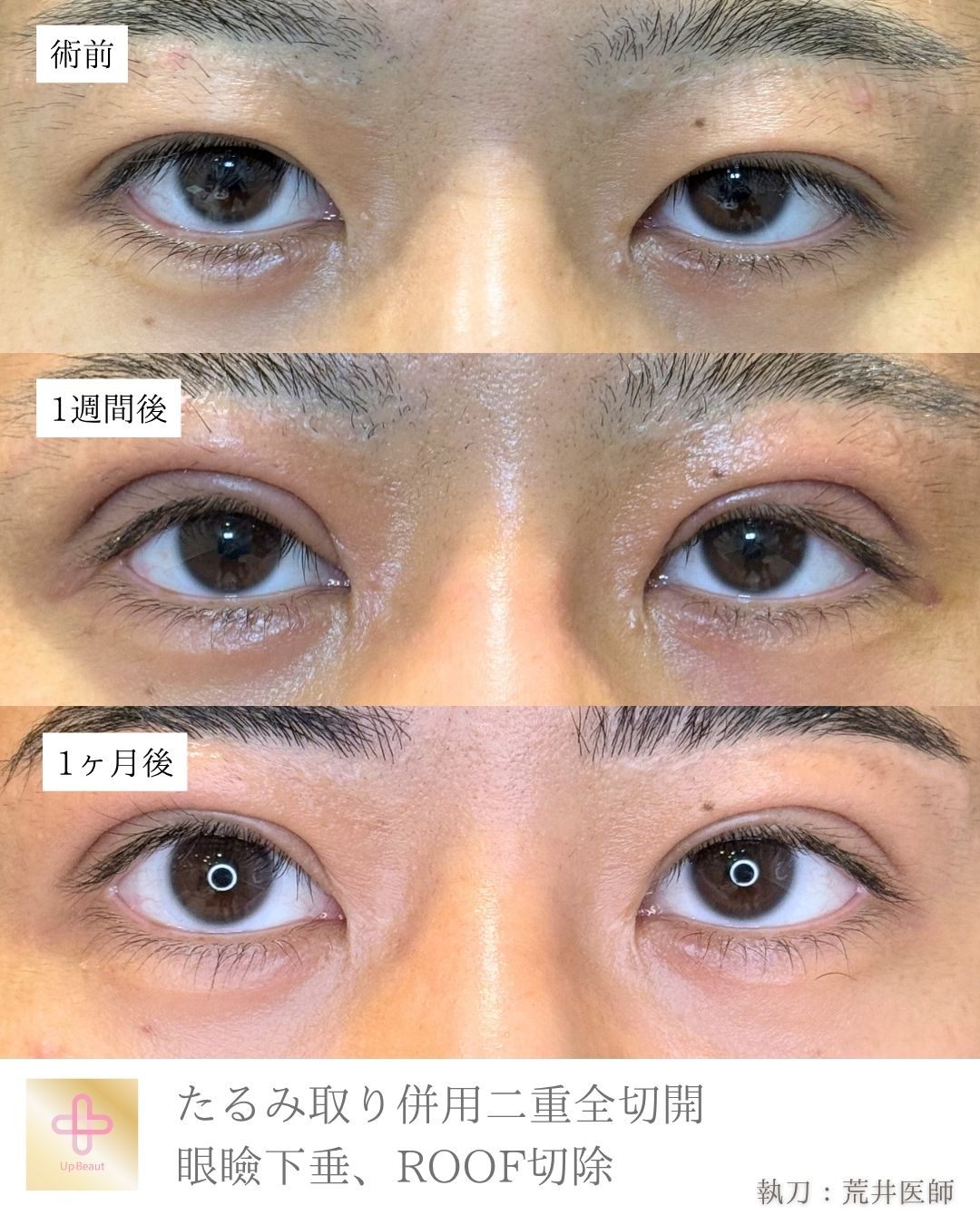 たるみ取り併用全切開二重術、眼瞼下垂 、ROOF切除