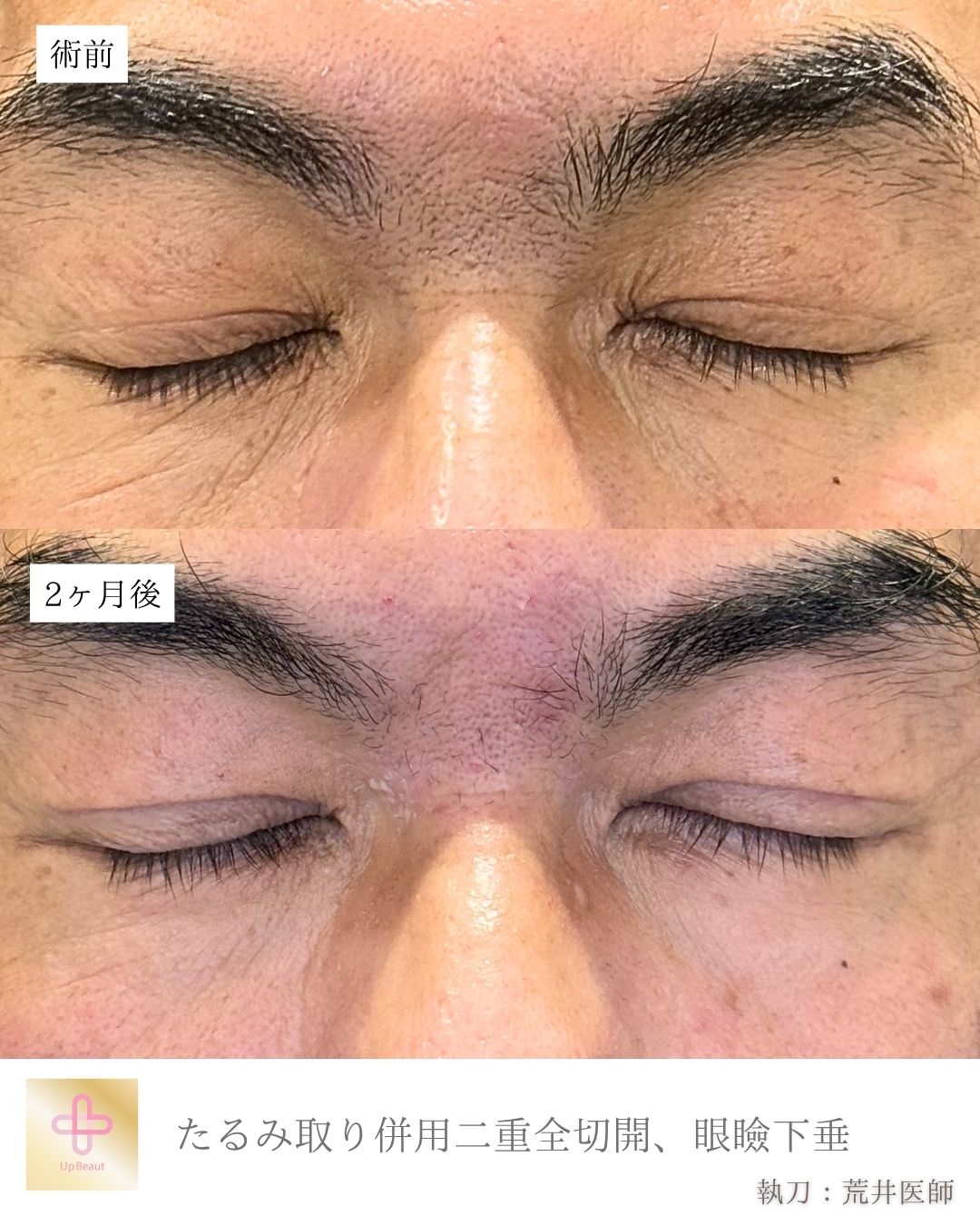 たるみ取り併用二重全切開、眼瞼下垂