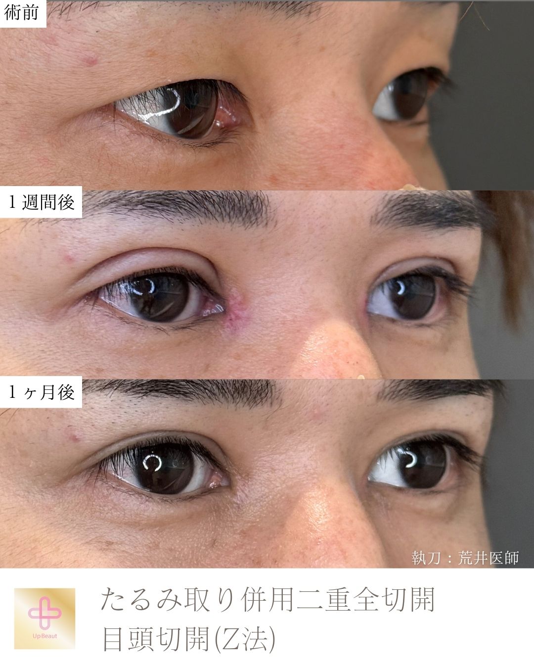 たるみ取り併用二重全切開、目頭切開 (Z法)