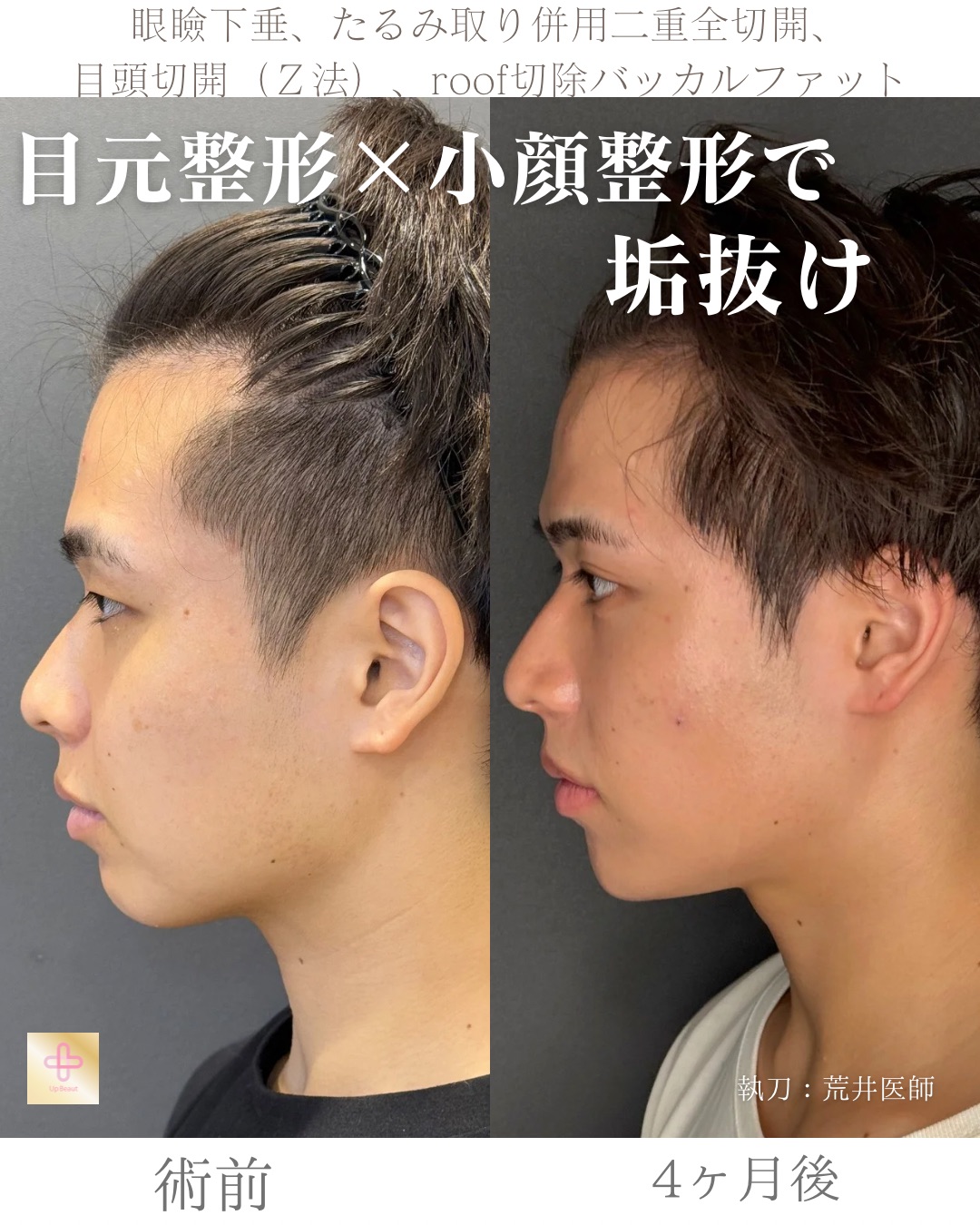 二重全切開たるみ取り併用、ROOF切除、眼瞼下垂、目頭切開(Z法)、バッカルファット、顎ヒアルロン酸1cc