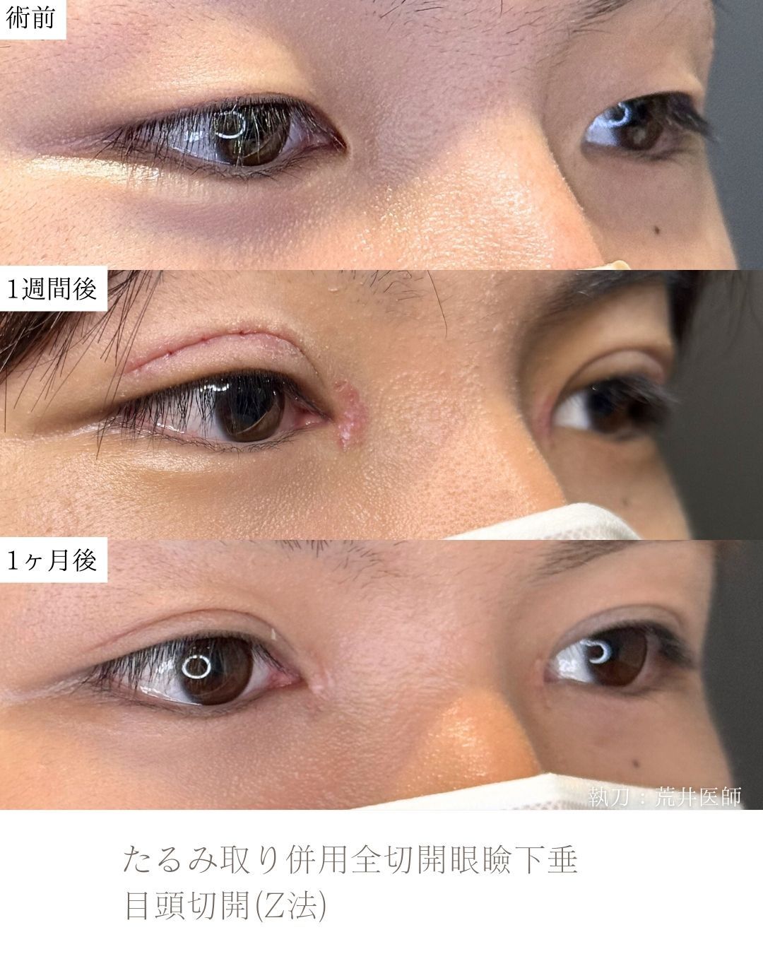二重全切開　目頭切開