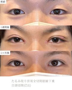 二重全切開　目頭切開