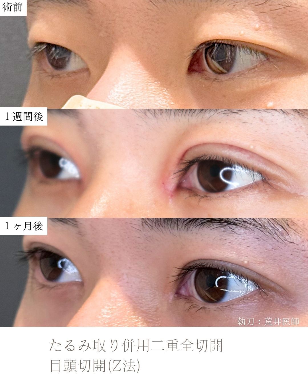たるみ取り併用二重全切開