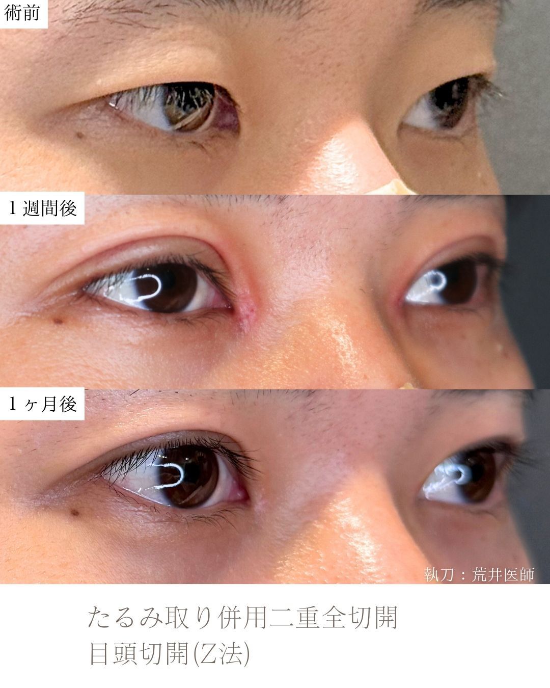 たるみ取り併用二重全切開