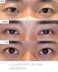 たるみ取り併用二重全切開