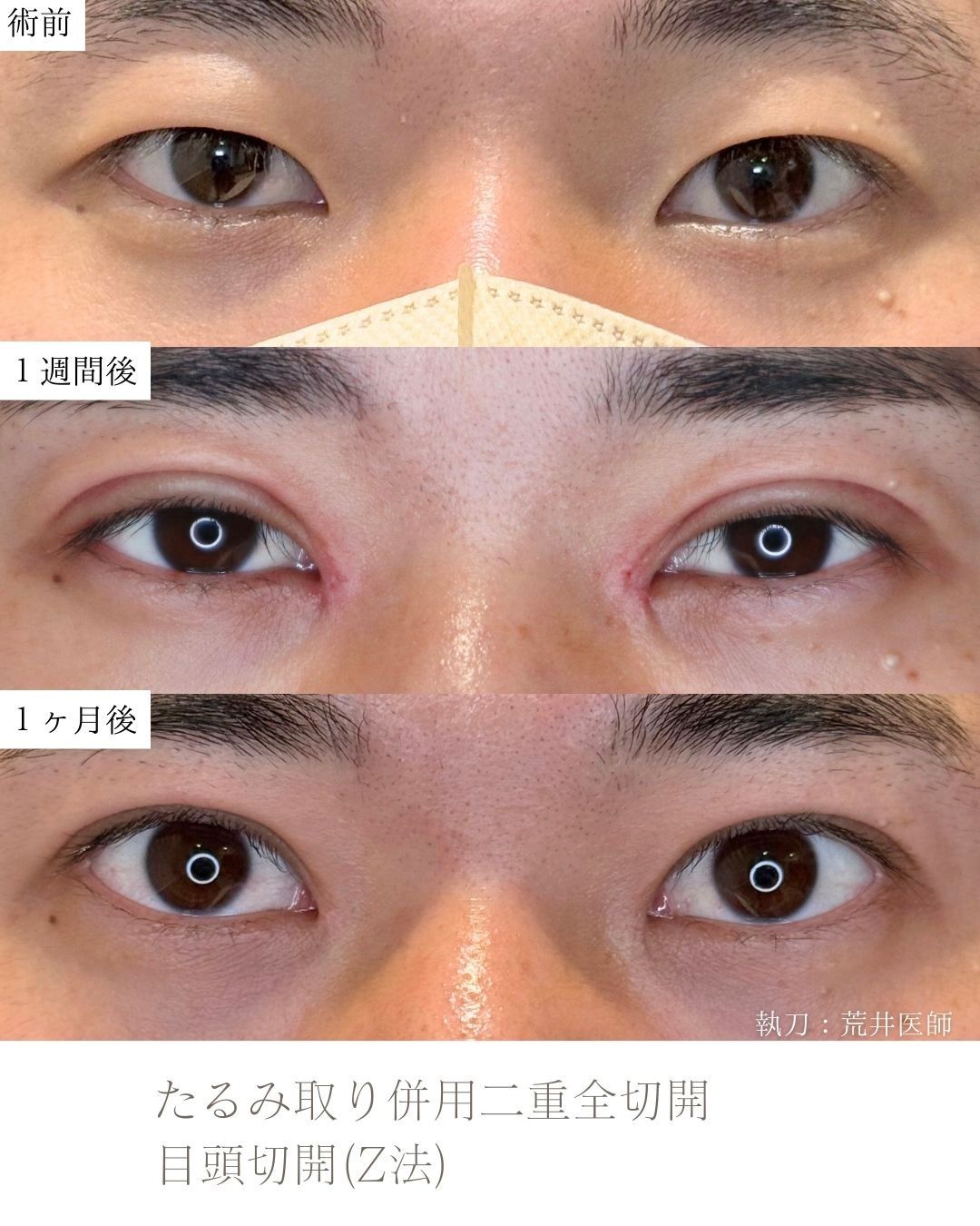たるみ取り併用二重全切開