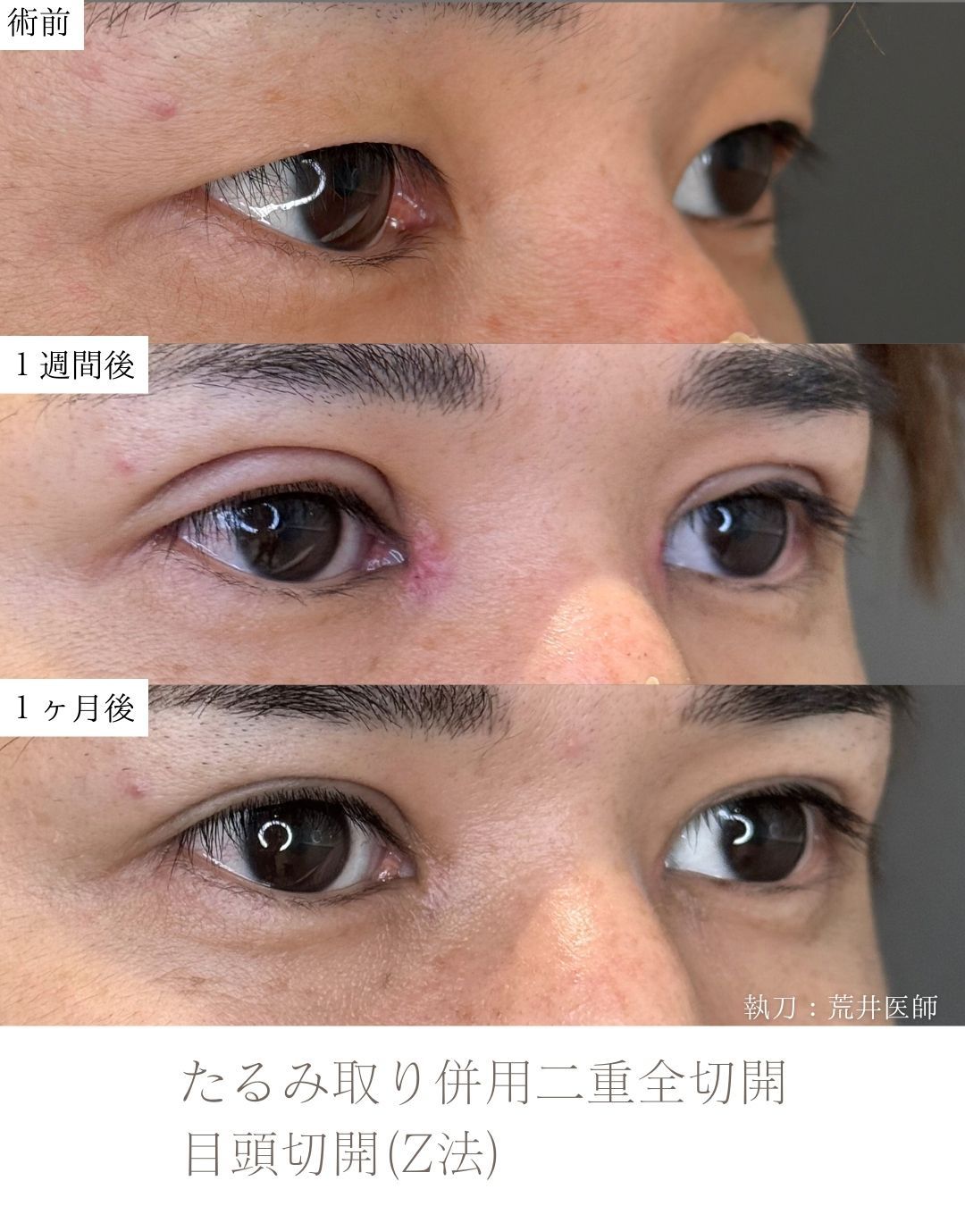 たるみ取り併用二重全切開