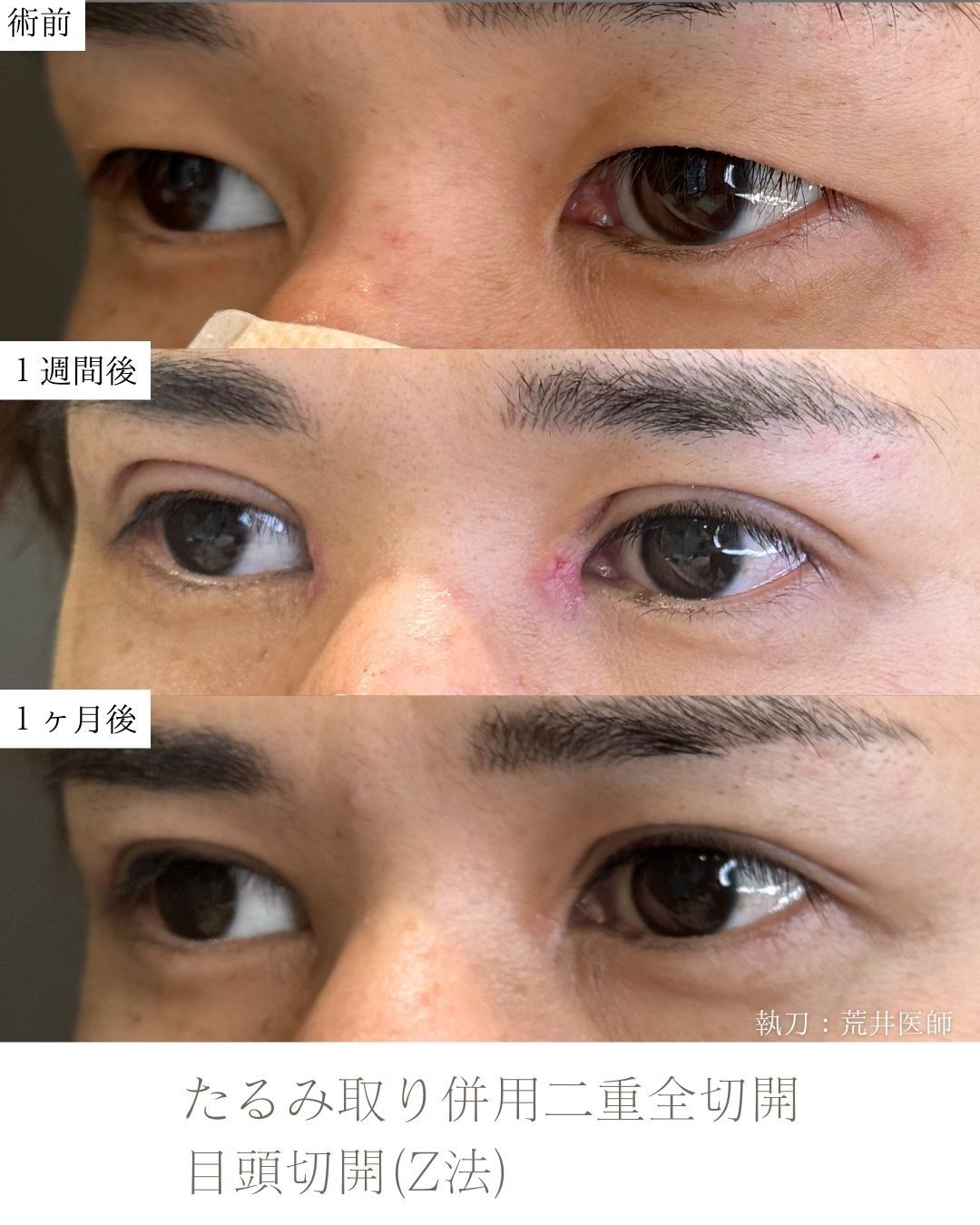 たるみ取り併用二重全切開