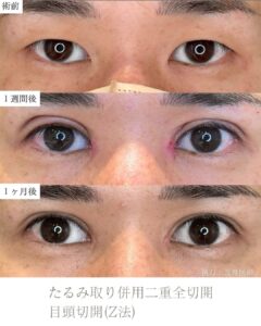 たるみ取り併用二重全切開