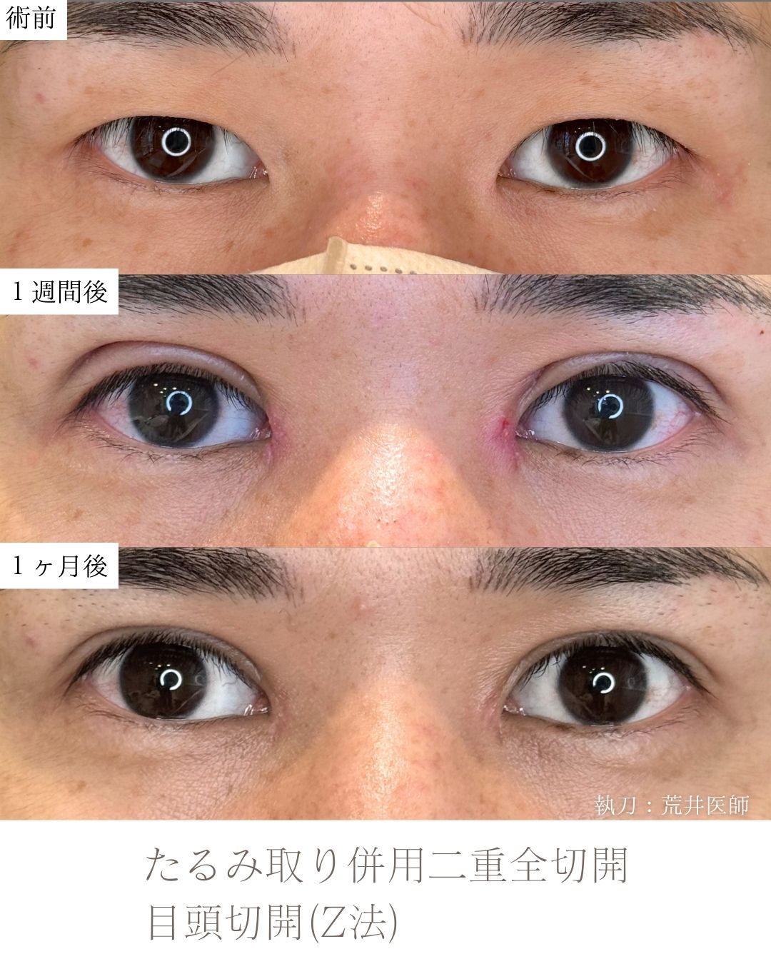たるみ取り併用二重全切開