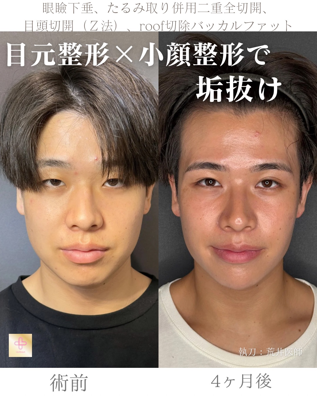 二重全切開たるみ取り併用、ROOF切除、眼瞼下垂、目頭切開(Z法)、バッカルファット、顎ヒアルロン酸1cc