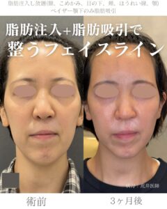 脂肪注入し放題　顎下脂肪吸引