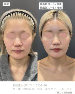 脂肪注入　脂肪吸引