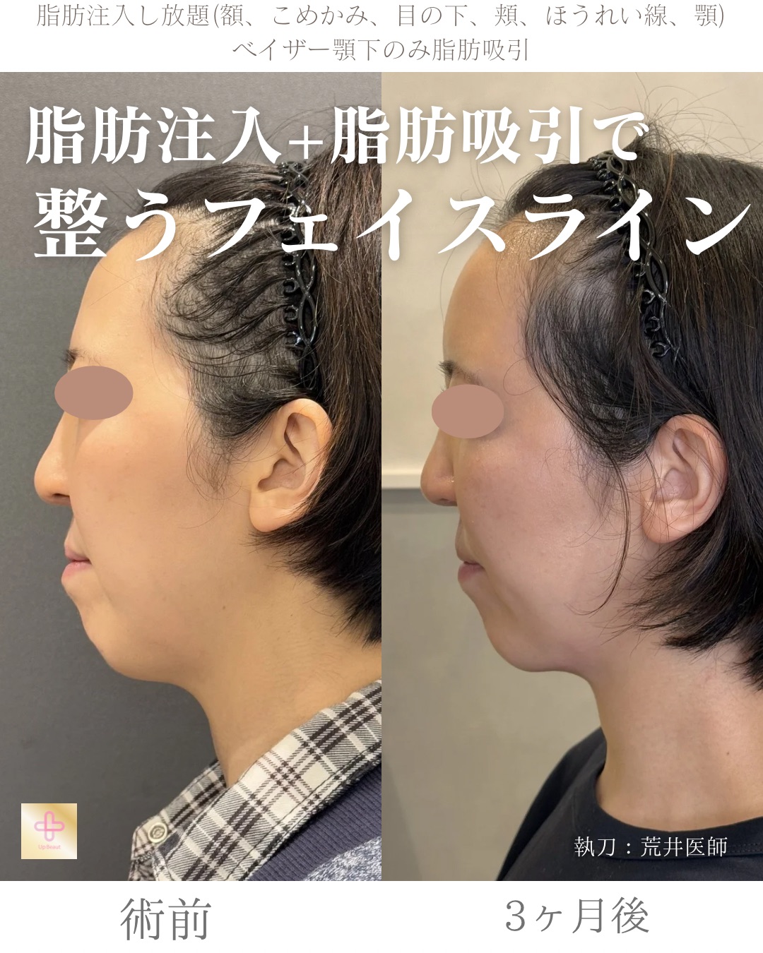 脂肪注入し放題、顎下脂肪吸引